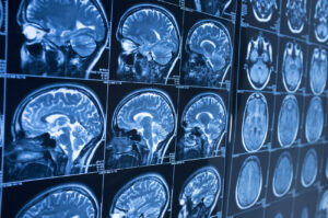 How Mark Casto Personal Injury Law Firm Can Help With a Brain Injury Claim in Columbus, GA